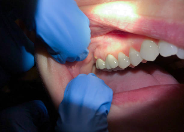 Best Emergency Dental Extractions in East Hazel Crest, IL